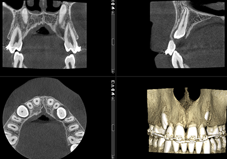 Dents incluses 150 μm