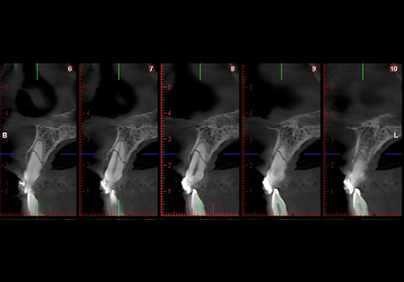 Fracture radiculaire