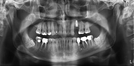 Panoramique adulte avec implant