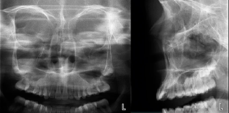 Sinus face et profil